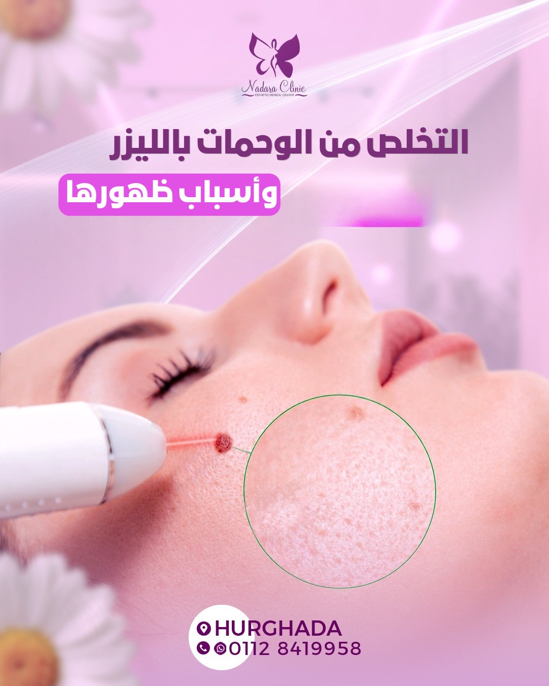 التخلص من الوحمات بالليزر وأسباب ظهورها في الغردقة